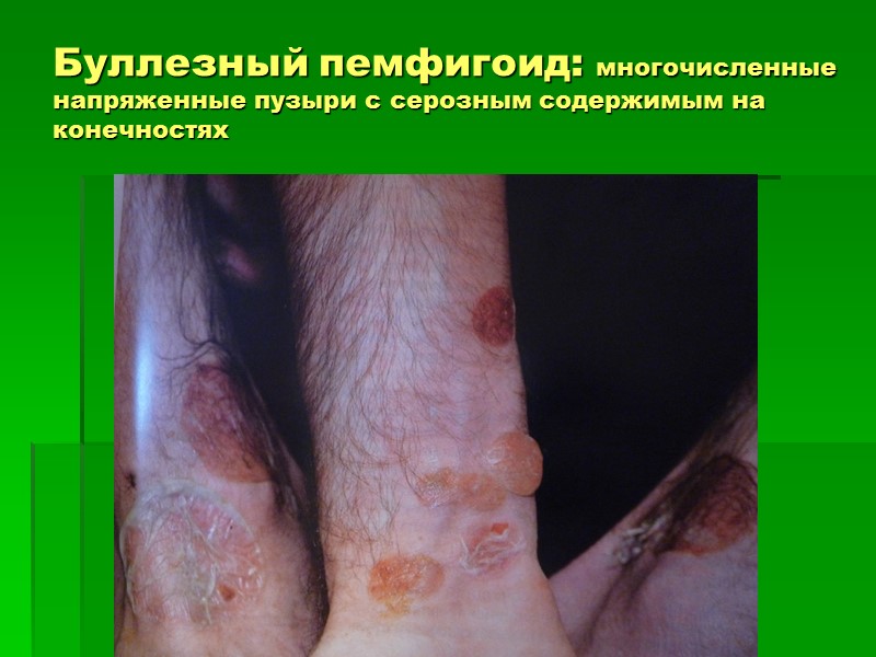 Буллезный пемфигоид: многочисленные напряженные пузыри с серозным содержимым на    конечностях